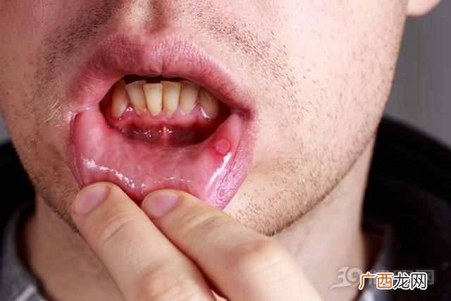 口腔溃疡了怎么办？5个快速有效的方法