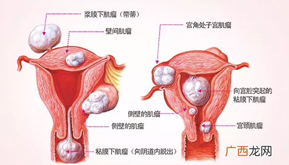 妊娠合并子宫肌瘤怎么处理？对母体和胎儿的影响