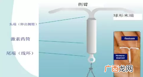 上曼月乐环可以缓解痛经吗