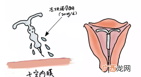 上曼月乐环月经量减少是怎么回事