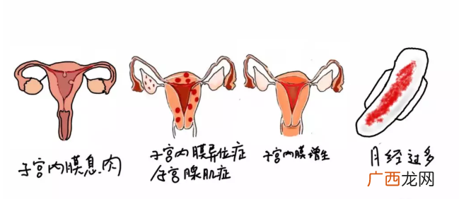 上曼月乐环月经量减少是怎么回事