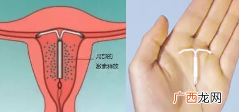 上曼月乐环流血有副作用吗 上曼月乐环后流血怎么回事