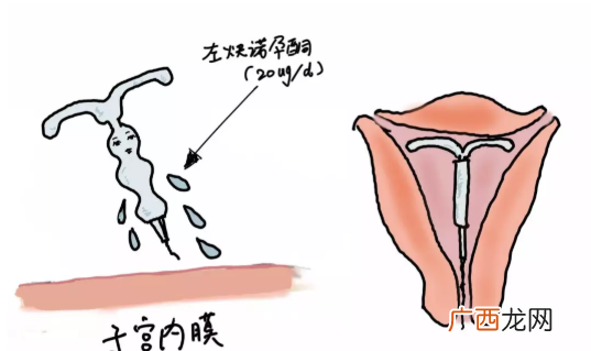 上曼月乐环对子宫有影响吗