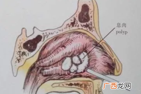 上曼月乐环对子宫有影响吗