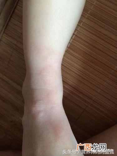 寻麻疹的症状以及最佳治疗方案