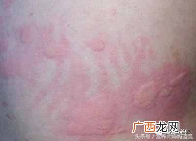 寻麻疹的症状以及最佳治疗方案