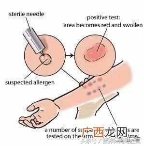 寻麻疹的症状以及最佳治疗方案