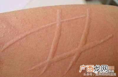 寻麻疹的症状以及最佳治疗方案