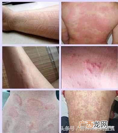 寻麻疹的症状以及最佳治疗方案