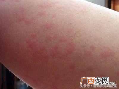 寻麻疹的症状以及最佳治疗方案