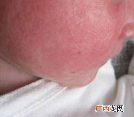 婴儿痱子?宝宝长痱子了该怎么办好