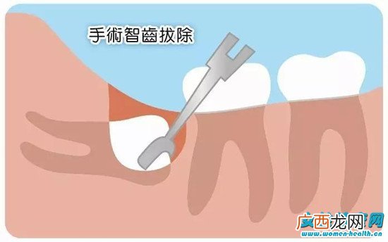 长智齿一定要拔吗 关于拔智齿的知识你懂多少