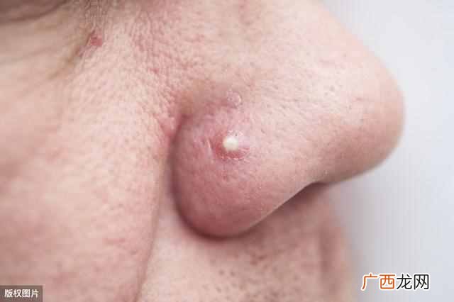 为什么脸上频繁长痘痘呢？专家为你答疑解惑让你皮肤嫩滑如鸡蛋