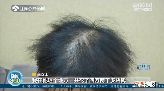 植发植发多少钱，女子花4.2万植发