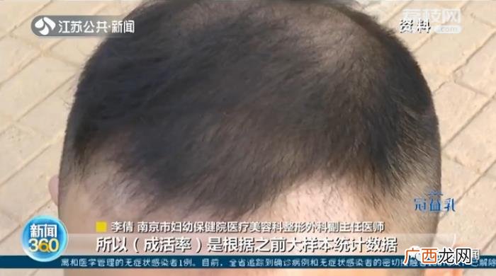 植发植发多少钱，女子花4.2万植发