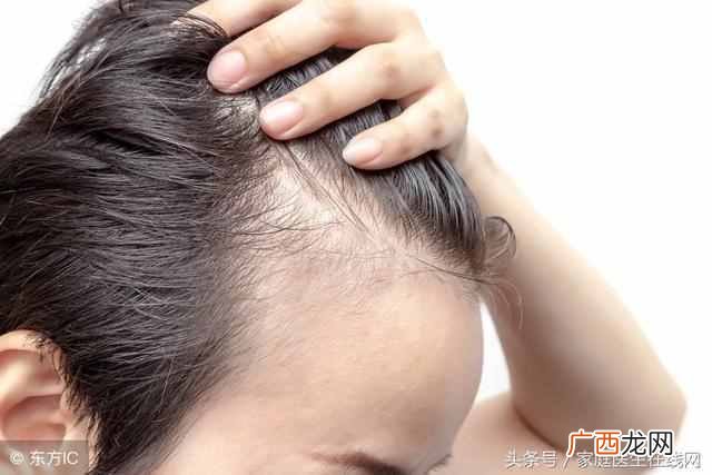 掉头发很厉害怎么办？脱发的原因以及治疗方法