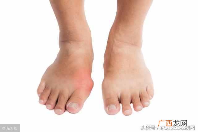 痛风不能吃什么东西，这些绝对不能吃！