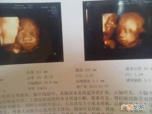 四维彩超最佳时间是几周（为什么要照四维彩超