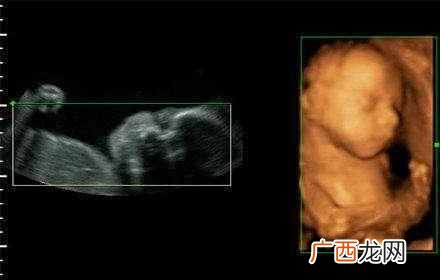 四维彩超最佳时间是几周（为什么要照四维彩超