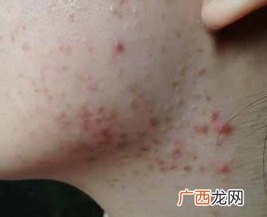 中医祛痘医院哪家比较有名（中医院祛痘效果怎