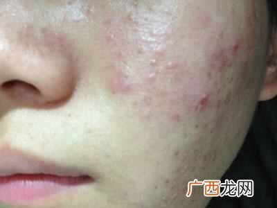 中医祛痘医院哪家比较有名（中医院祛痘效果怎