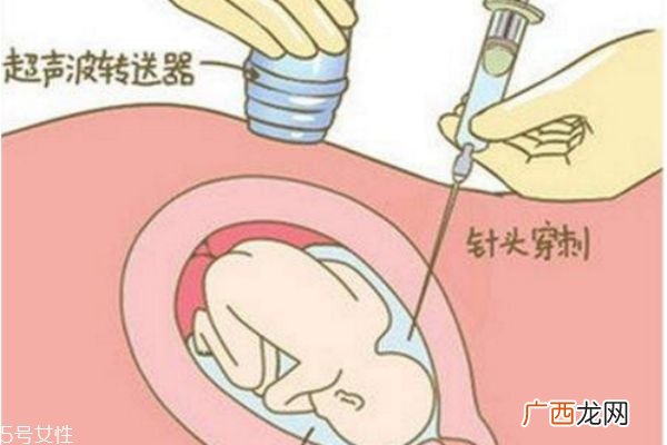 孕妇做羊水穿刺对胎儿有影响吗