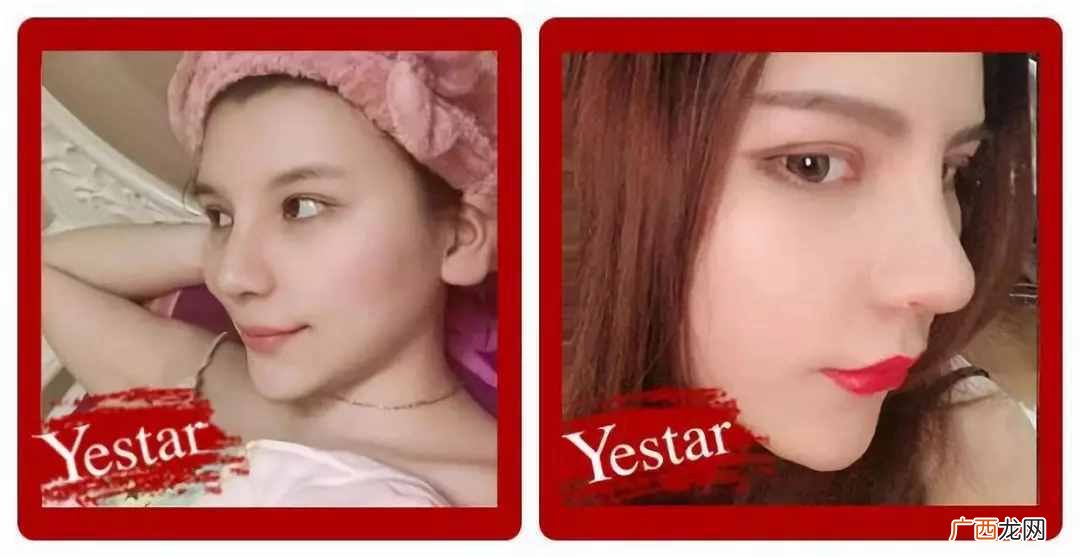 仿生隆鼻好不好，有什么坏处（仿生隆鼻用什么