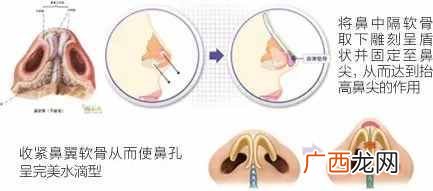仿生隆鼻好不好，有什么坏处（仿生隆鼻用什么