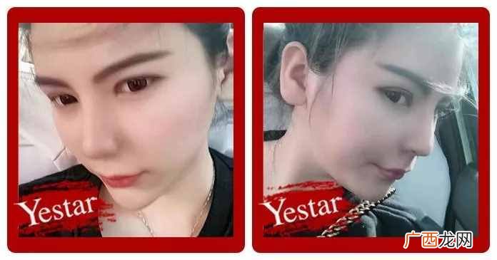 仿生隆鼻好不好，有什么坏处（仿生隆鼻用什么