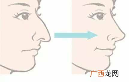 仿生隆鼻好不好，有什么坏处（仿生隆鼻用什么