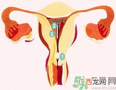 上环的最佳时间是什么时候?上环的坏处是什么?