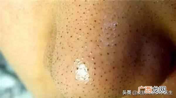 上海治疗青春痘医院排名，上海治疗青春痘医院