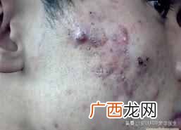 上海治疗青春痘医院排名，上海治疗青春痘医院