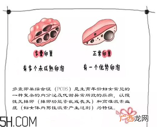 多囊卵巢生不了？多囊卵巢怀孕要看准时间