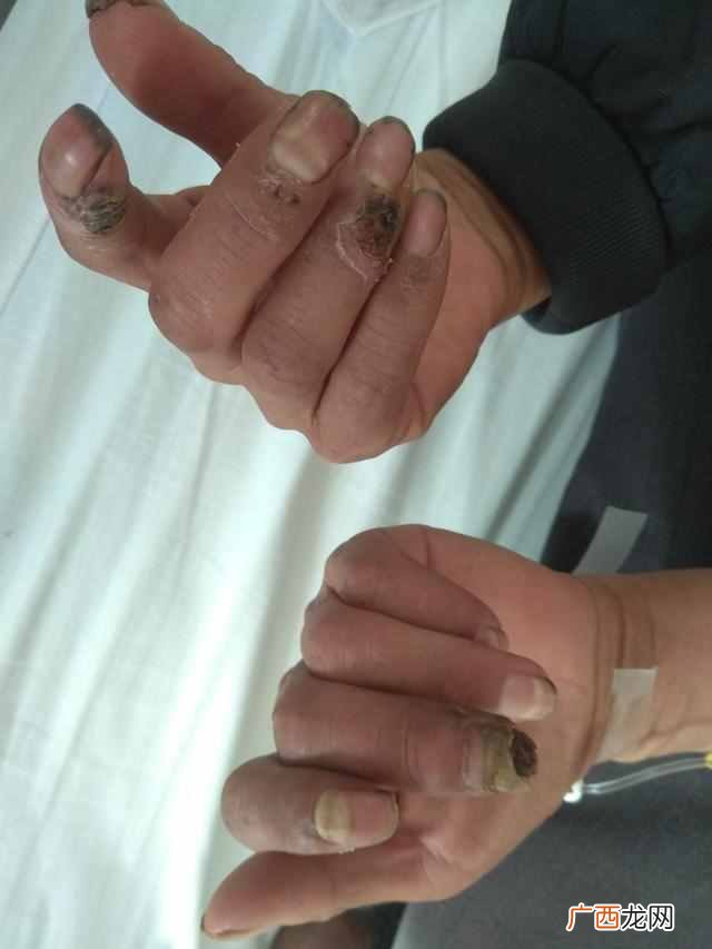 脉管炎医院,郑州哪个医院看脉管炎好