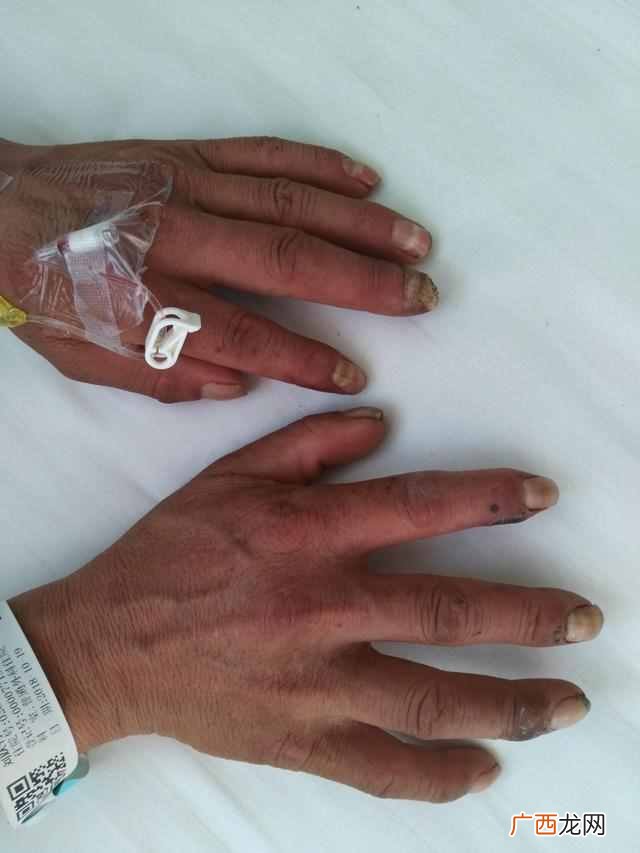 脉管炎医院,郑州哪个医院看脉管炎好