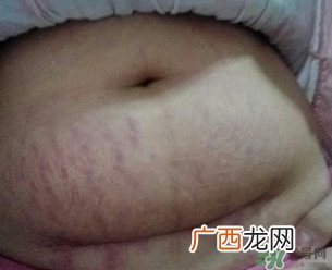孕妇肚子上的黑线能看出生男生女吗?