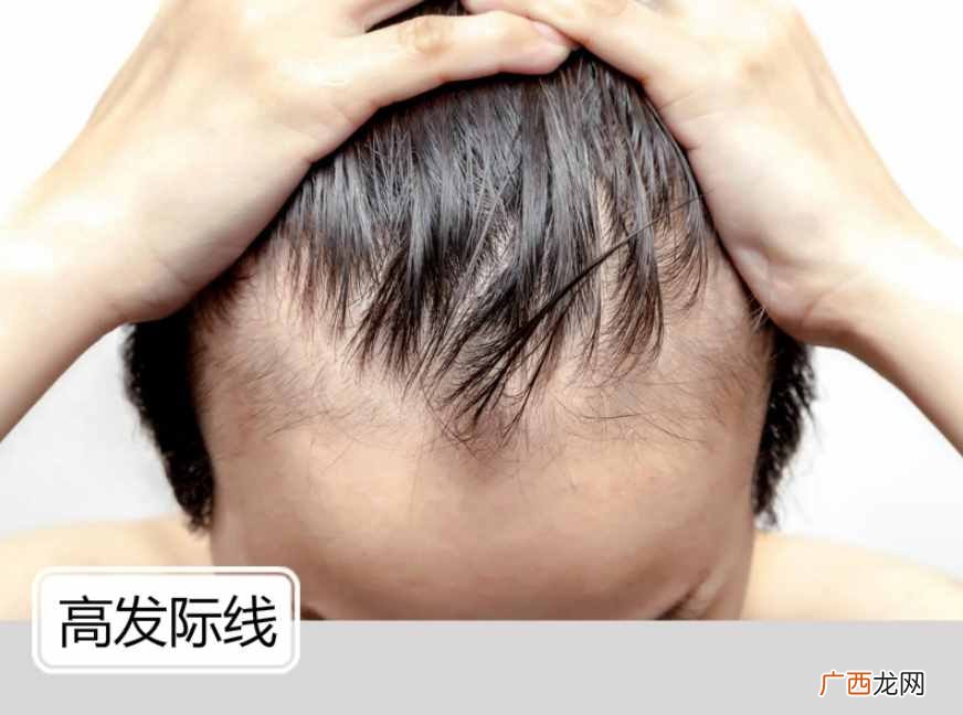 6种高发际线发型让你帅爆炸 男生额头高适合什么发型图片