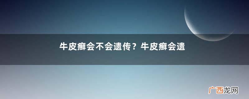 牛皮癣会不会遗传？牛皮癣会遗传给孩子吗？