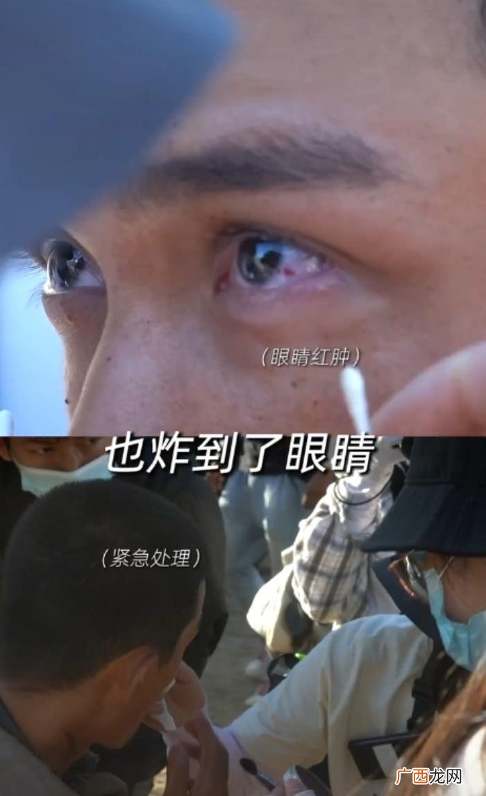 吴磊的眼睛，吴磊拍戏意外炸伤眼睛