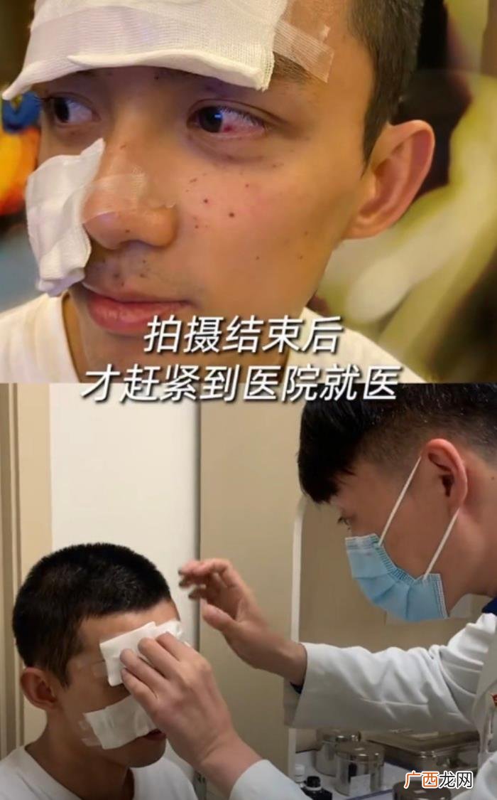 吴磊的眼睛，吴磊拍戏意外炸伤眼睛