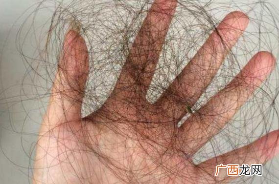 产后脱发严重怎么治疗才有效产后脱发原因是什么