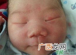 新生儿脸上长小白点是怎么回事?是什么原因?