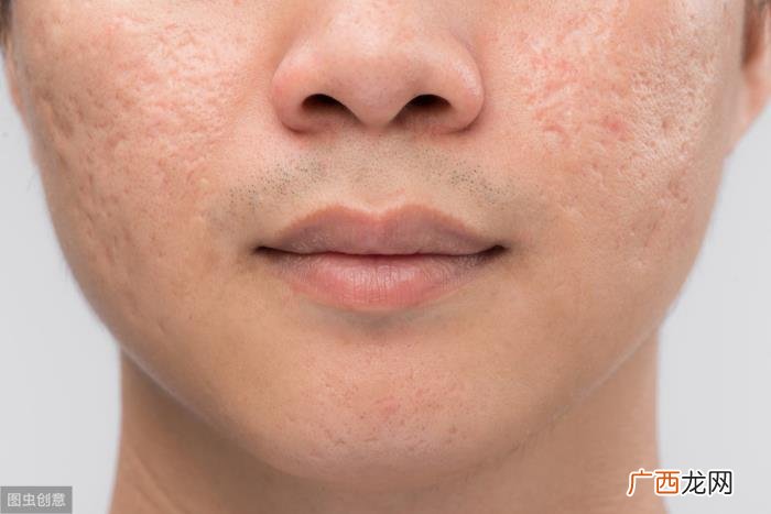 男士毛孔粗大怎么改善 男士毛孔粗大怎么办