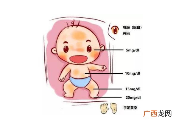 新生儿黄疸会造成什么影响新生儿黄疸会嗜睡吗