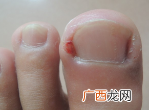 怎样预防儿童甲沟炎如何治疗
