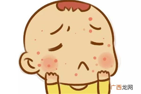 宝宝耳朵湿疹怎么办宝宝湿疹什么原因造成的
