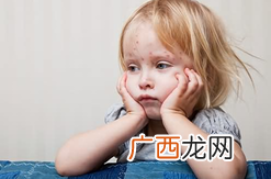 小孩子长水痘怎么治疗如何防止传染