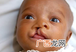 什么原因导致宝宝兔唇如何治疗