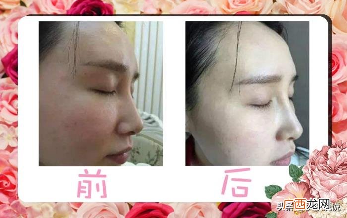奢侈护肤和光子美白谁优谁劣 光子嫩肤可以美白吗
